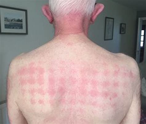 Photosensitivity Rash Photos