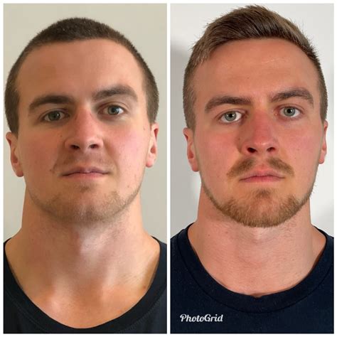 How I Fixed Mild Obstructive Sleep Apnea And Transformed My Face