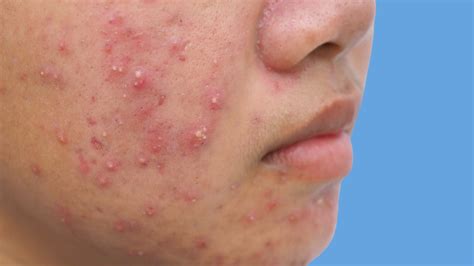 Hormonal Cystic Acne On The Chin | DermOnDemand