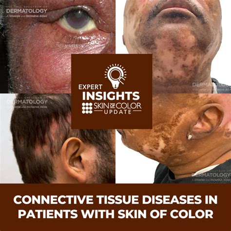 Mixed Connective Tissue Disease Eyes at JENENGE blog