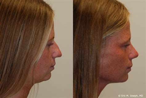 Eric M. Joseph, MD | Rhinoplasty Before & After: Deviated Septum Correction