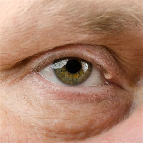 Ptosis (Droopy Eyelid) Treatment - Treasure Coast Eye Specialists
