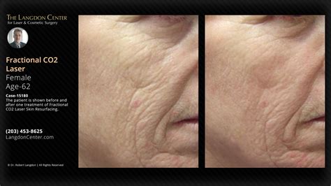 Best Fractional CO2 Laser Treatment | Top Skin Rejuvenation Experts | Shoreline Center ...
