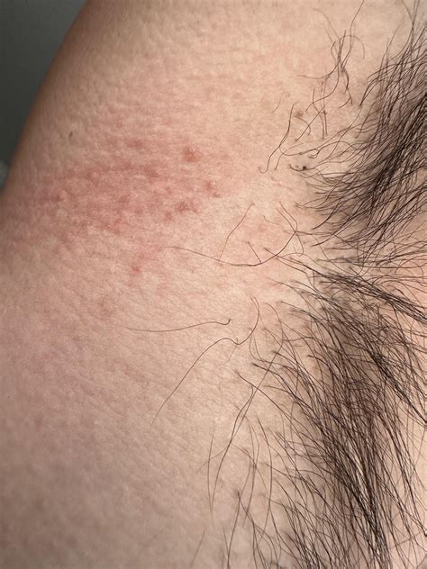 Armpit rash: fungal or eczema? : r/Dermatology