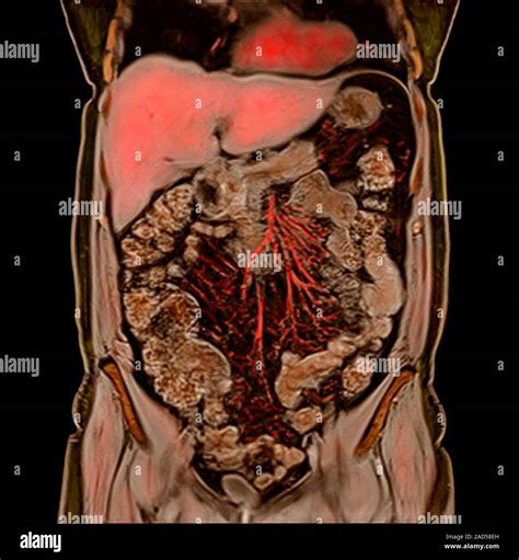 Mri Of Abdomen