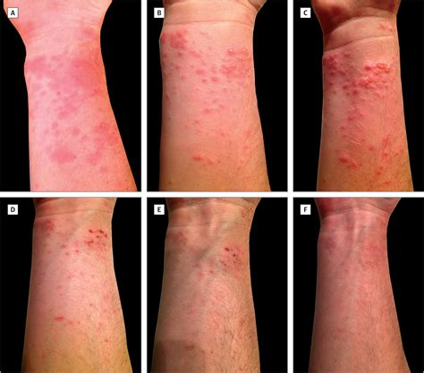 What Are The Effects Of A Box Jellyfish Sting at Martin Loya blog