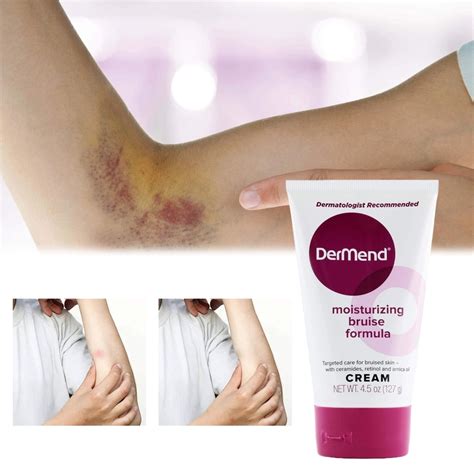 Dermend Bruise Cream Extra Strength,Bruise Cream Extra Strength Fast Healing Thin Skin,Dermend ...