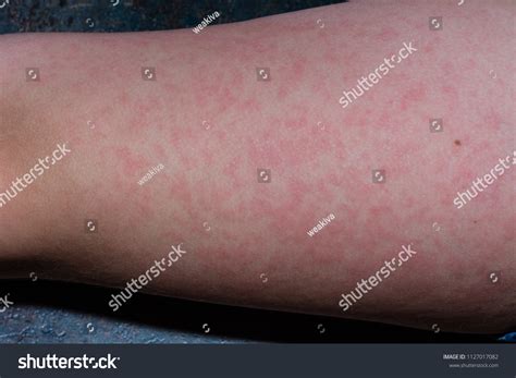 Fifth disease rash: malar rash and body rash | fifth disease rash pictures – LPVHU
