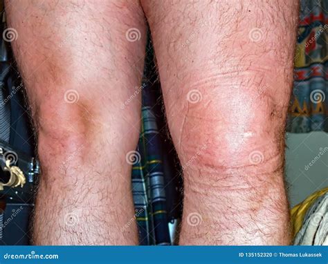 Swollen Left Foot Comparison After Wasp Sting On Female Foot Royalty ...