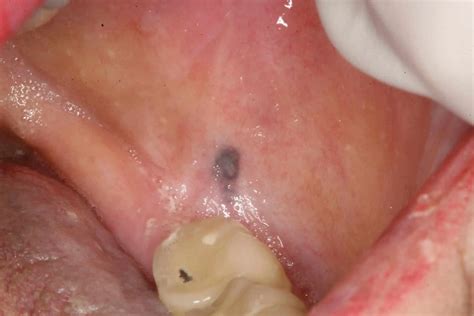 Painless Black Spot Inside Cheek Pictures