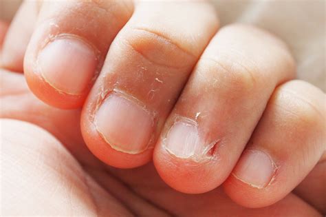 Trichotillomania (Hair Pulling) & Onychophagia / Dermatophagia (Nail / Skin Biting) | Causes ...