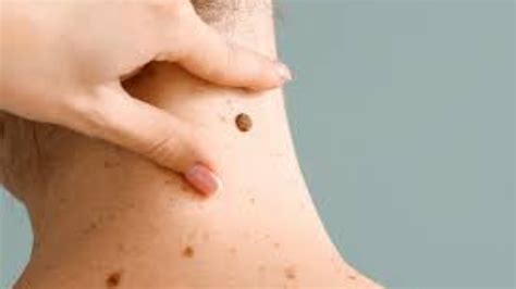 Skin Tags: Causes, Treatments, and Prevention - Dr. Praneeth Skin Hair Laser Clinic