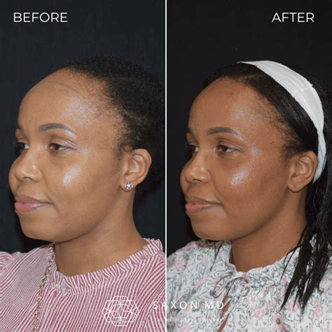 Women Receding Hairline