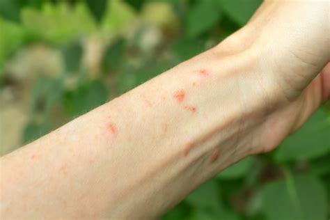 Shingles vs. Poison Ivy: How to Tell the Difference