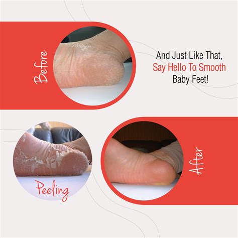 Baby Feet Peel Baby Foot Original Exfoliant Foot Peel Sale 2021 | The