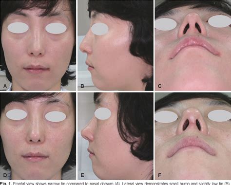 Figure 2 from Diagnosis and Treatment of Dynamic External Nasal Valve ...
