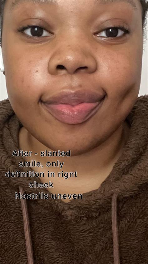 Jaw surgery ruined my face (before/after) : r/jawsurgery