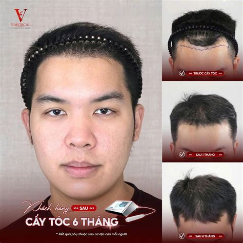 công nghệ cấy tóc mới nhất | Vmedicalclinic.vn