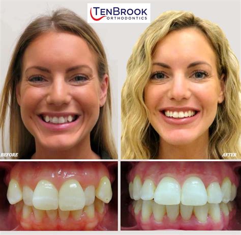 TenBrook T1 Braces® | Fastest Orthodontic Treatment