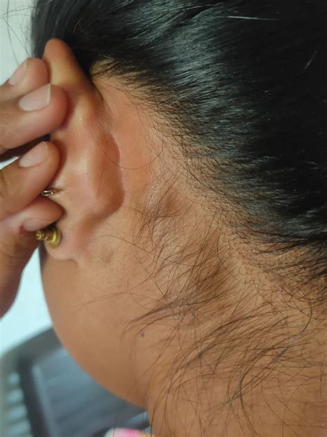 Lump Behind Both Ears: Causes & Treatments