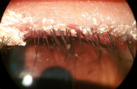 Demodex Blepharitis: Symptoms, Causes, and Treatment Options ...