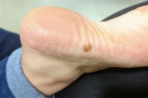 How would you treat this lesion on the sole of the foot?