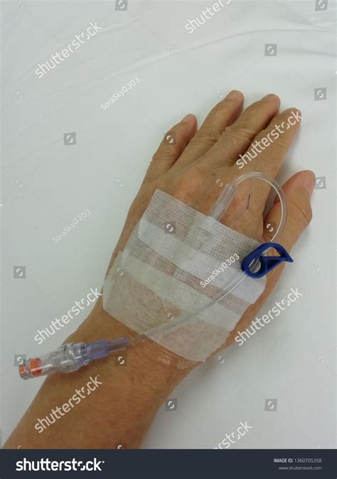 What Is A Catheter Lock at Jean Fitzgerald blog