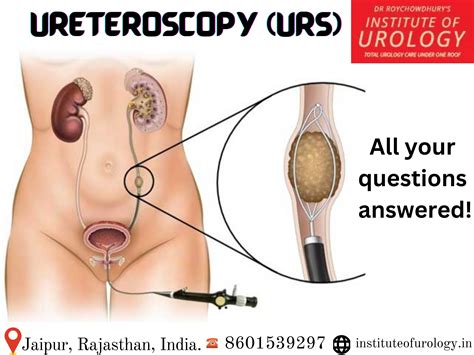 Ureteroscopy Procedure Ureteroscopy Brisbane Urology Clinic