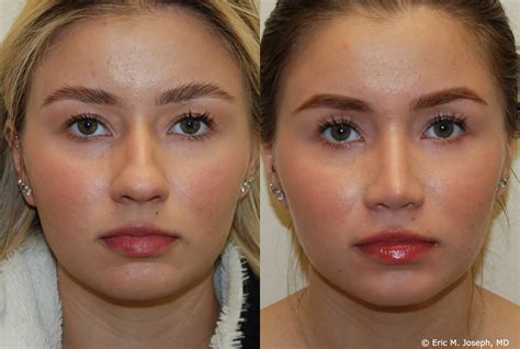 Eric M. Joseph, MD | Rhinoplasty Before & After: Hump Removal and Tip Correction