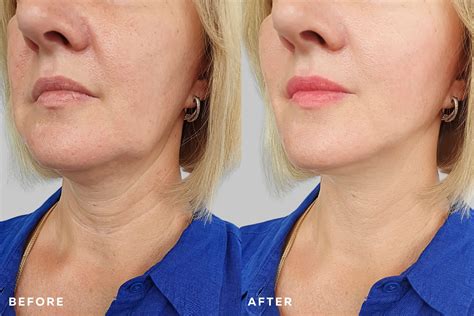 Jowls Treatments - Freyja Medical