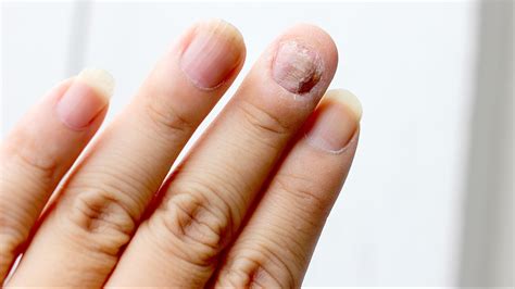 Fingernail Fungus From Acrylic Nails: Causes & Care