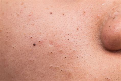 How To Get Rid Of Blackheads On Side Of Face