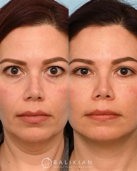 Facial Fat Transfer Before & After Gallery : Real Transformations
