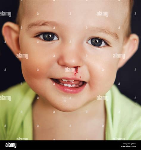 Happy toddler baby boy with a bloody nose. Bleeding from the nose of a ...