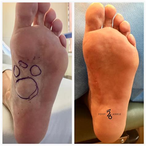 Foot Health Facts Plantar Fibroma at Rachel Fairweather blog