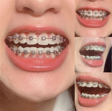 Brackets Dientes En Ingles at Zane Pellot blog