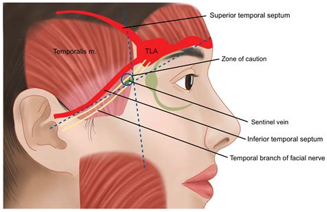 An Expert Guide to Anatomy-Based Filler Injection for the Temple ...