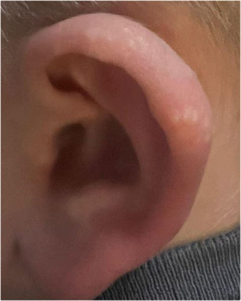 Juvenile Spring Eruption: Twice is Not Nice - The Journal of Pediatrics