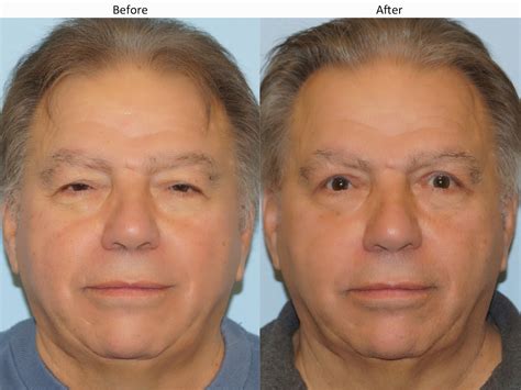 Facial Plastic Surgery: Lazy eye, Ptosis repair, Upper blepharoplasty ...