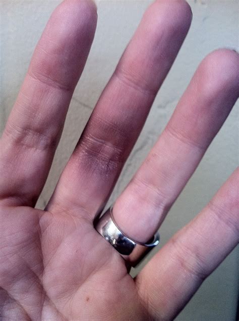 Why Do I Break Blood Vessels In My Hands at Jason Quinn blog