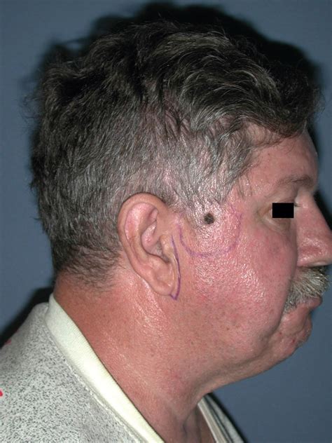 Upper Facial Reconstruction - Clinical Tree