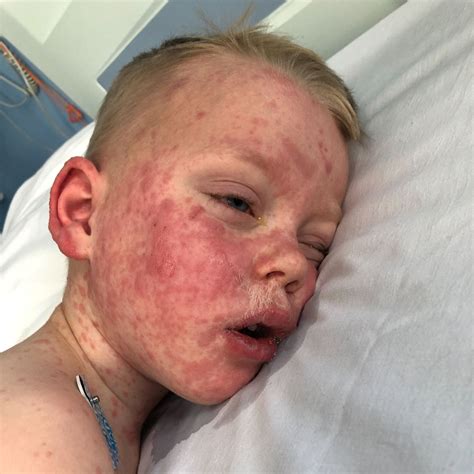 Steven Johnson Syndrome In Children