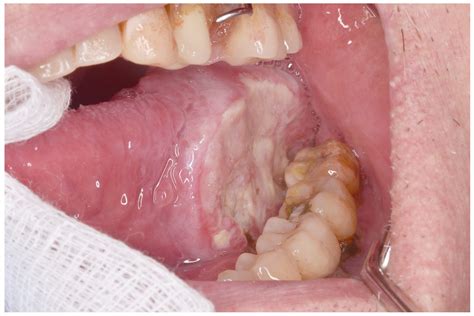 Malignant Transformation of Proliferative Verrucous Leukoplakia: A Description of the Clinical ...