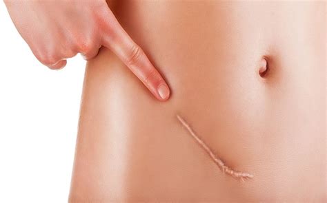 How Much Does Scar Revision Surgery Cost?