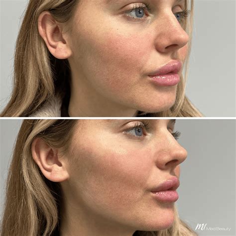 Before and After treatment pictures - M1 Med Beauty UK
