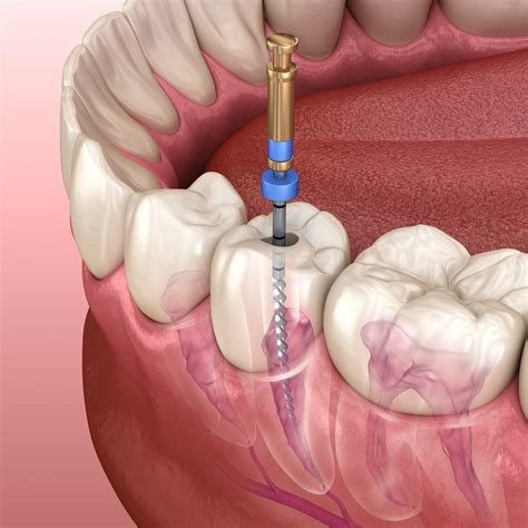 Root Canal Treatment (RCT) - Smile & Move Polyclinic