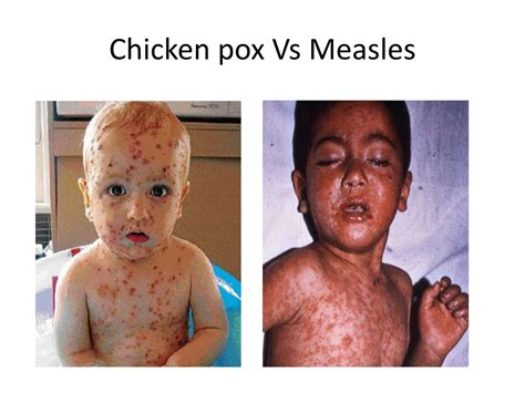 PPT - Chickenpox and Herpes Zoster: A Comparison and Control Strategies ...