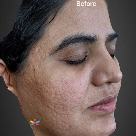 Halo Laser Treatments - Spotless Laser