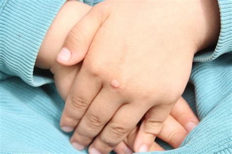 Managing Warts and Molluscum Contagiosum