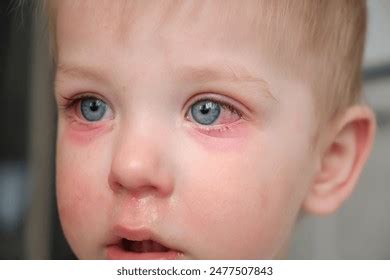 Red Swollen Eyes Conjunctivitis Child Ill Stock Photo 2477507843 ...